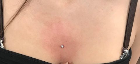 surface e microdermal